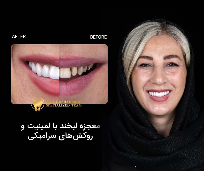 معجزه لبخند با لمینیت و روکش های سرامیکی